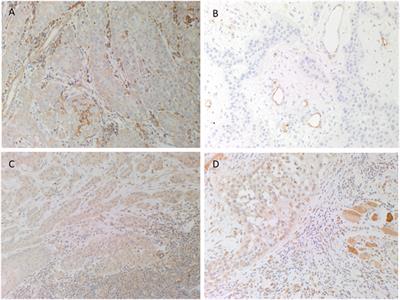 Cancer Stem Cells in Moderately Differentiated Lip Squamous Cell Carcinoma Express Components of the Renin–Angiotensin System